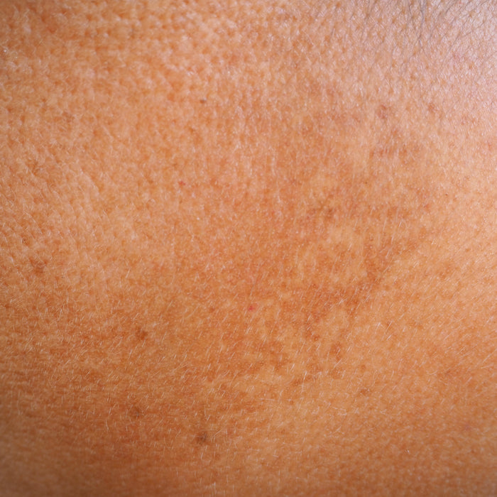 Why It's Unsafe to Use Hyperpigmentation Products During Pregnanc