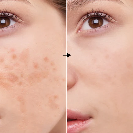 Unveiling the Power of Kojic Acid: Benefits and Usage for Flawless Skin