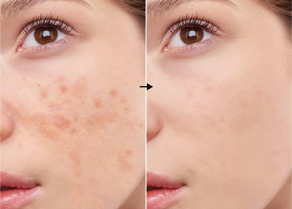 Unveiling the Power of Kojic Acid: Benefits and Usage for Flawless Skin